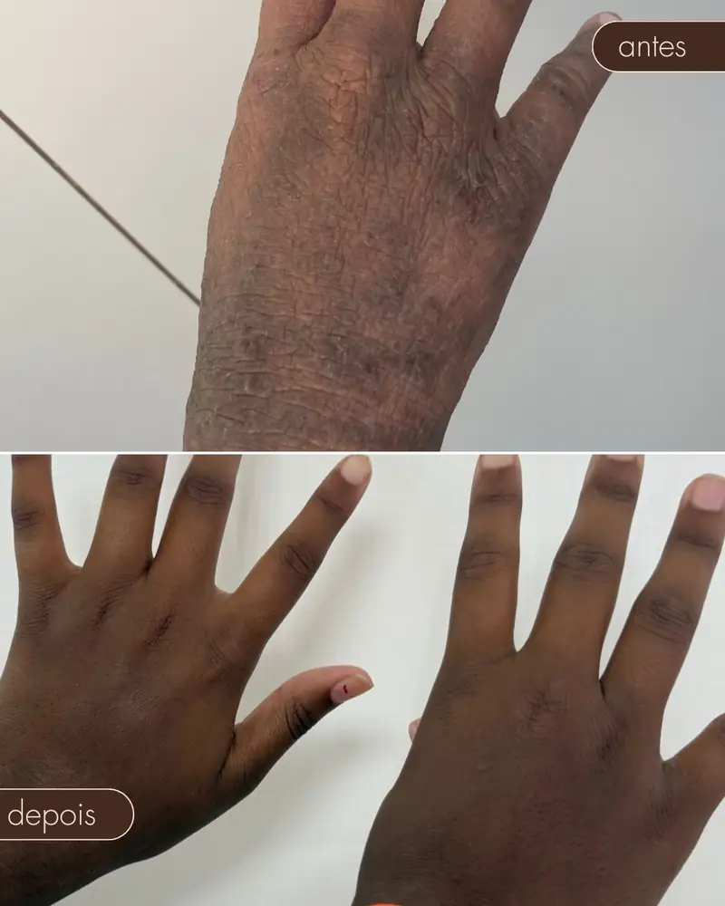 Antes e depois — Tratamento de psoríase